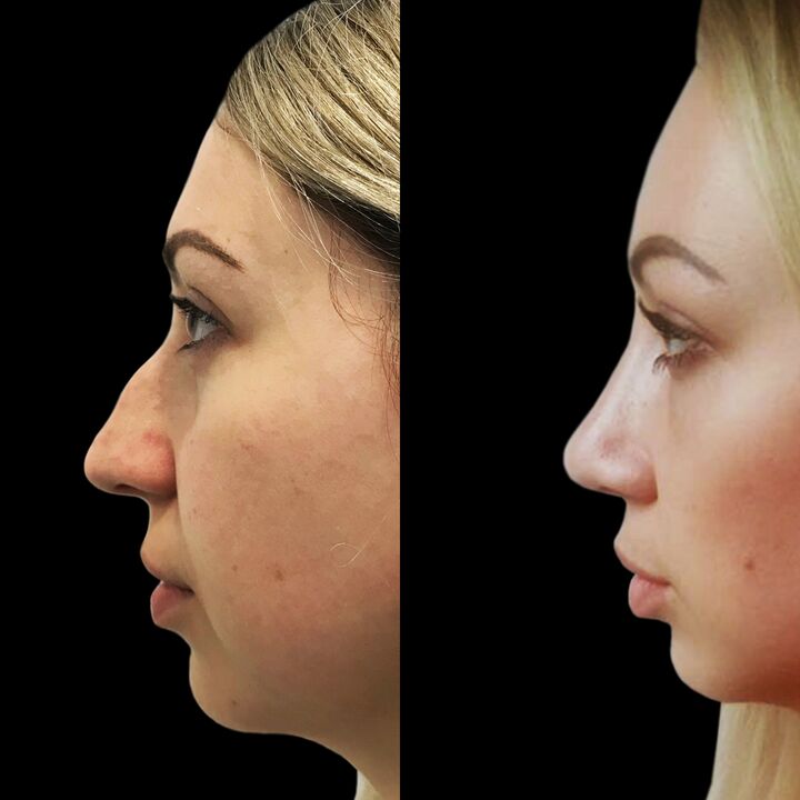 Rinoplastik