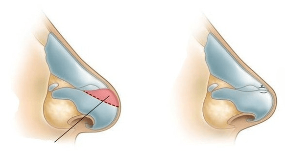 Korrektur der Nasenform