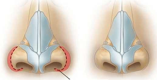 Verkleinerung der Nasenlöcher