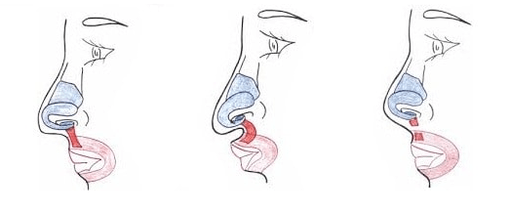 Verkürzung eines Teils des Nasenmuskels