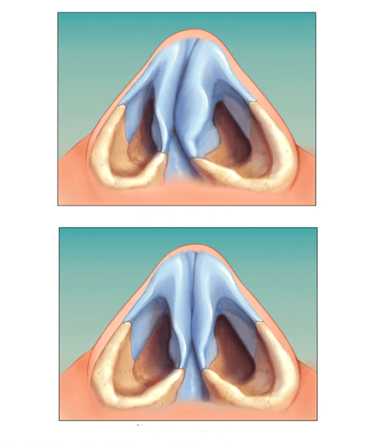 korrigiertes Nasenseptum