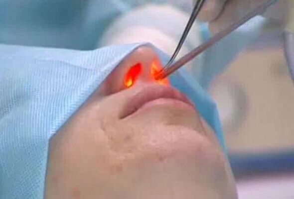 Laser-Nasenkorrektur der Nase
