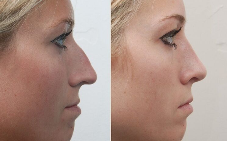 vor und nach Nasenkorrektur