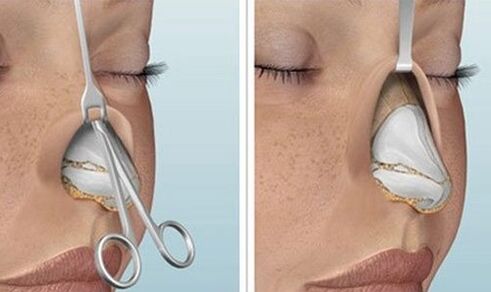 Nasenkorrektur mit offener Nase