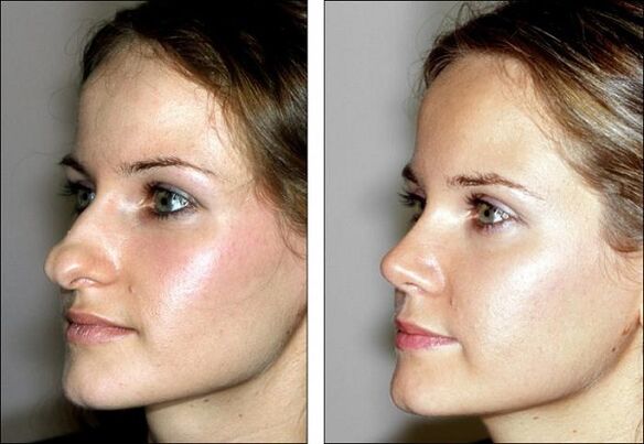Fotos vor und nach der Nasenkorrektur