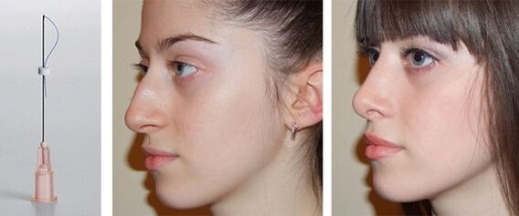 vor und nach Nasenkorrektur mit Mesothreads