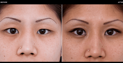 vor und nach Augenoperationen