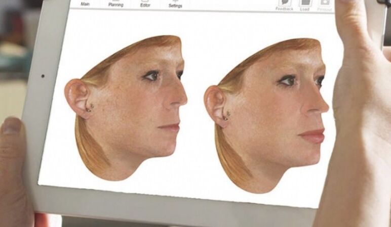 Methode der Computermodellierung der Nase vor der Nasenkorrektur