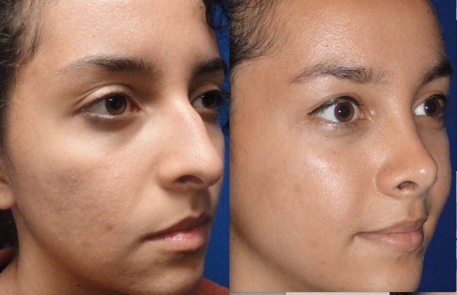 Vorher-Nachher-Fotos der geschlossenen Nasenkorrektur