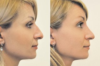 Nicht-invasive Nasenkorrektur, Fotos vor und nach