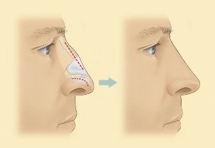 Wie läuft die Nasenkorrektur schonende